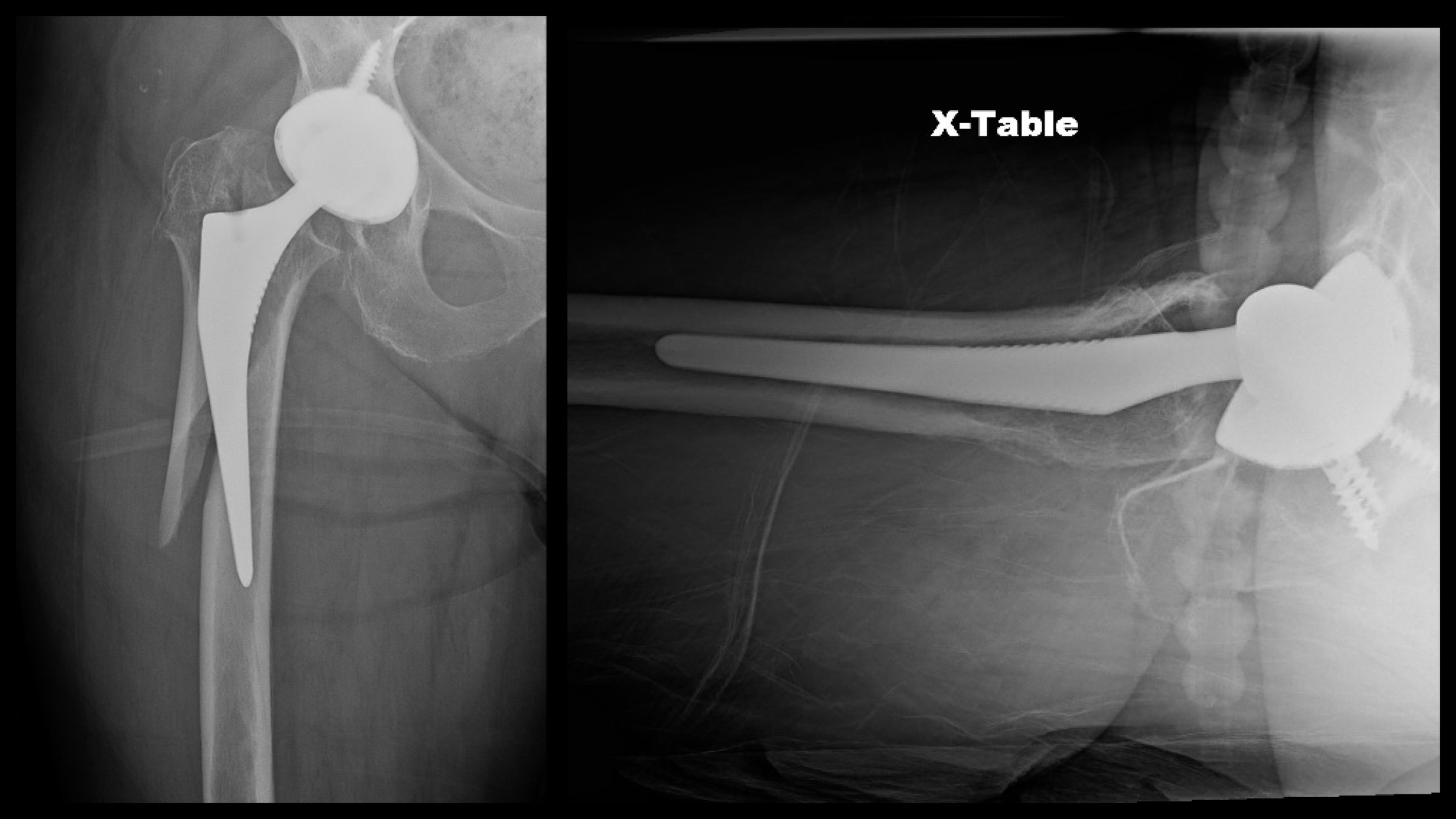 Periprosthetic Femur Fracture ORIF Stem Revision