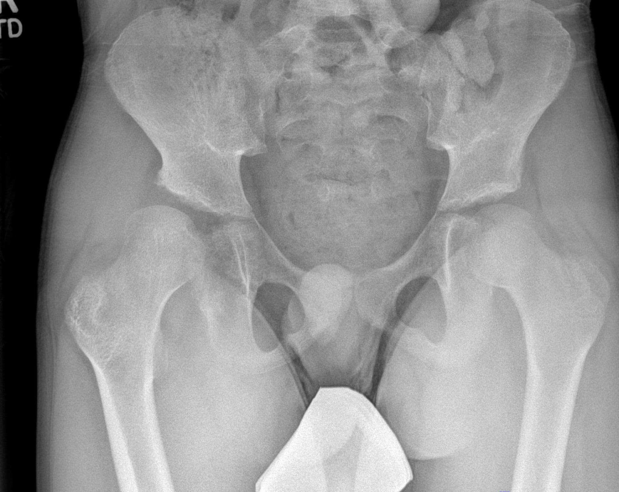 Varus Derotational Osteotomy of Proximal Femur