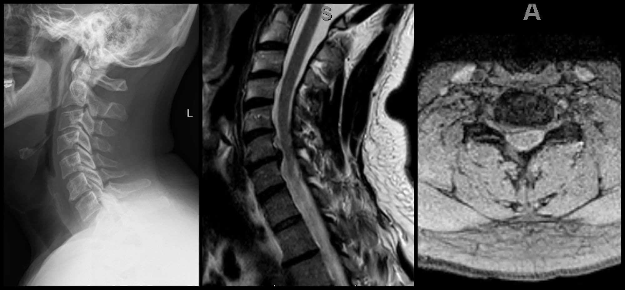 Cervical Disc Replacement