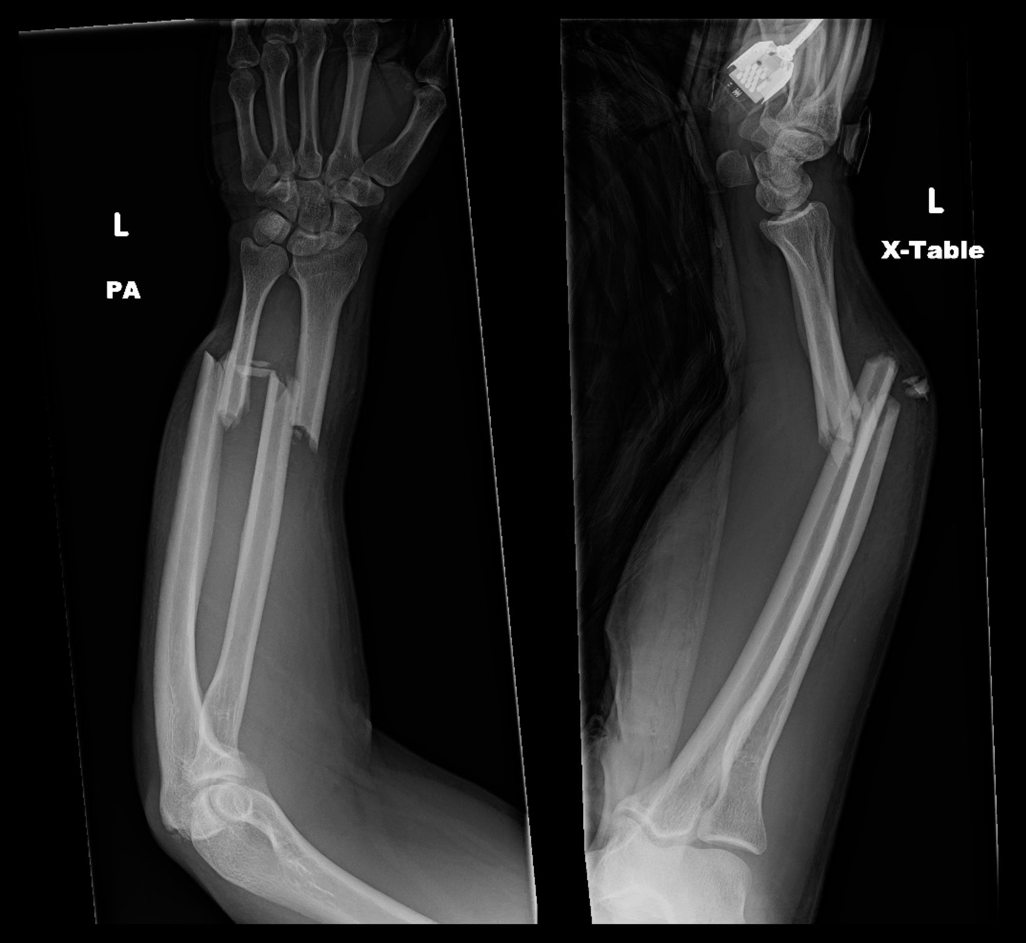 ulna bone fracture