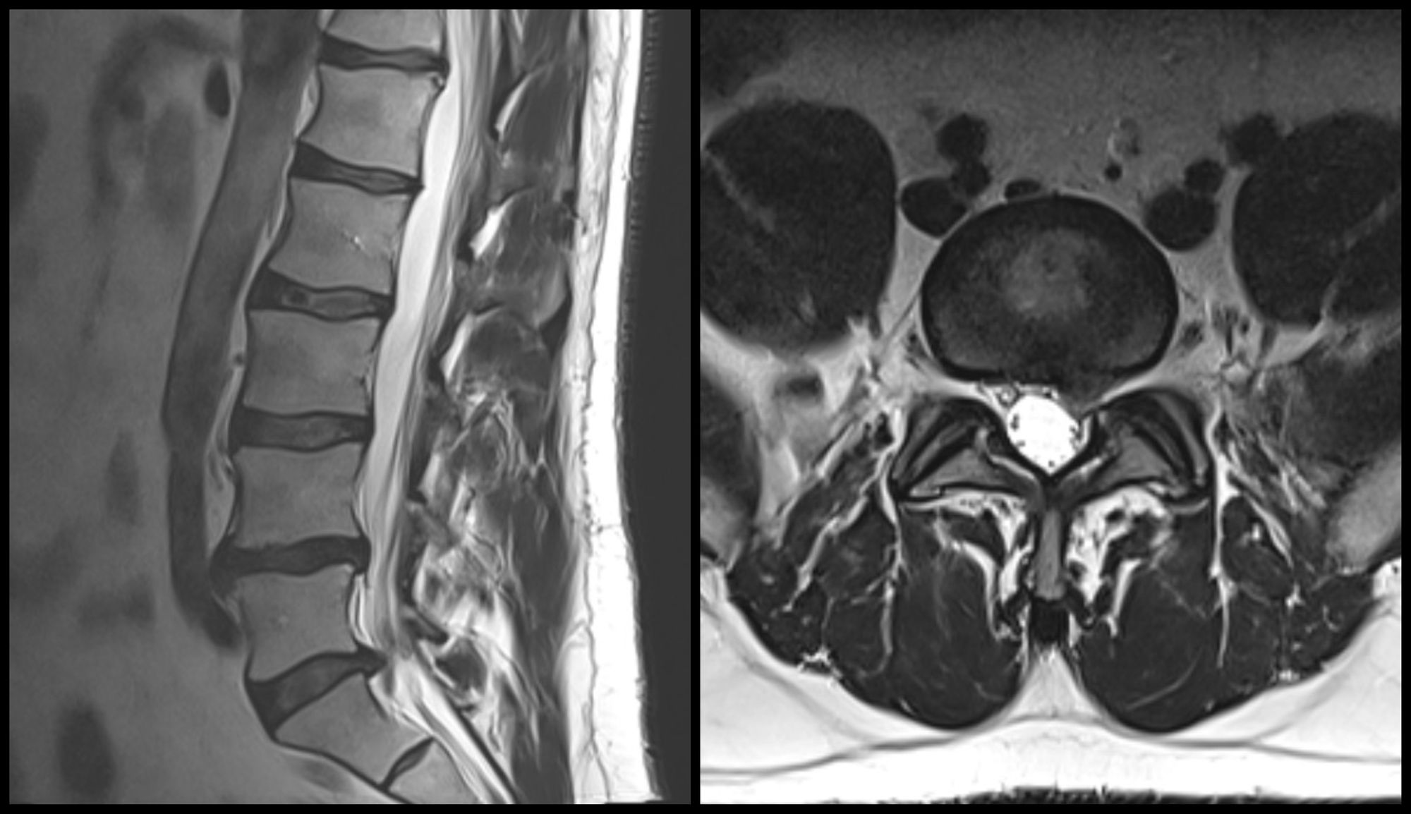 L5 S1 Microdiscectomy 0534