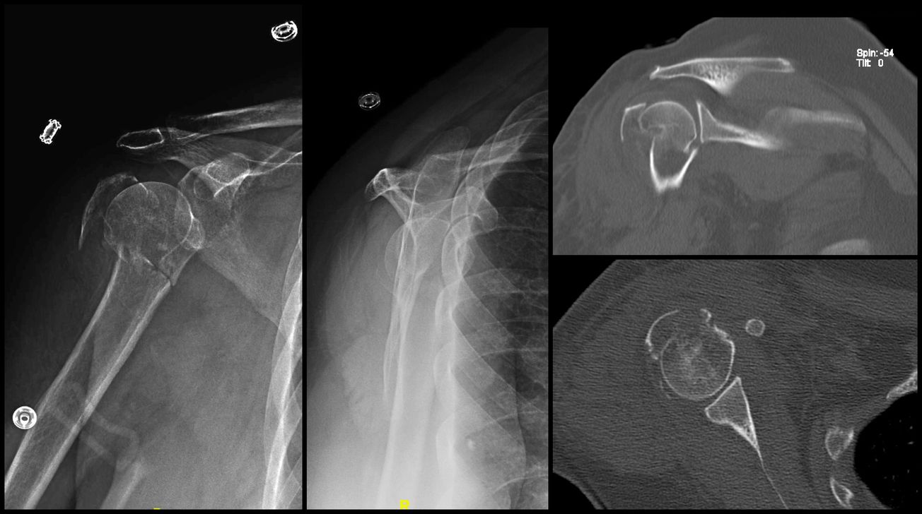 Segmental Humerus Orif