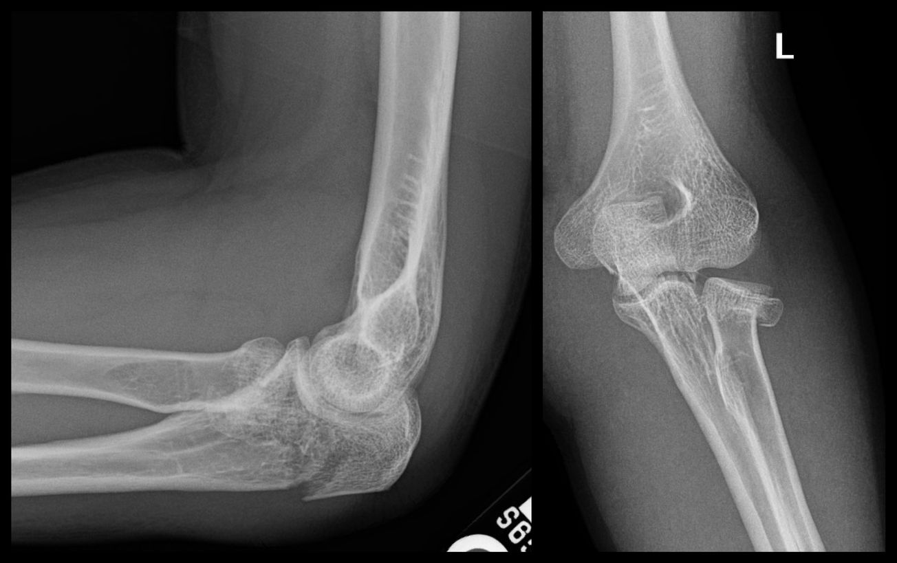 Radiusulna Shaft Both Bone Forearm Orif