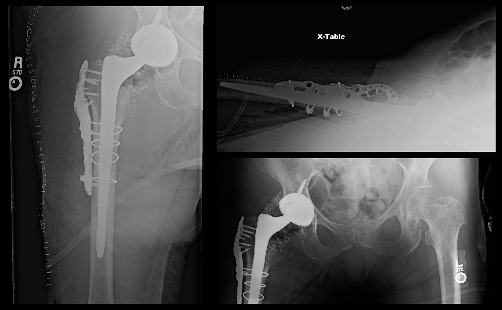 Periprosthetic Femur Fracture Orif Stem Revision