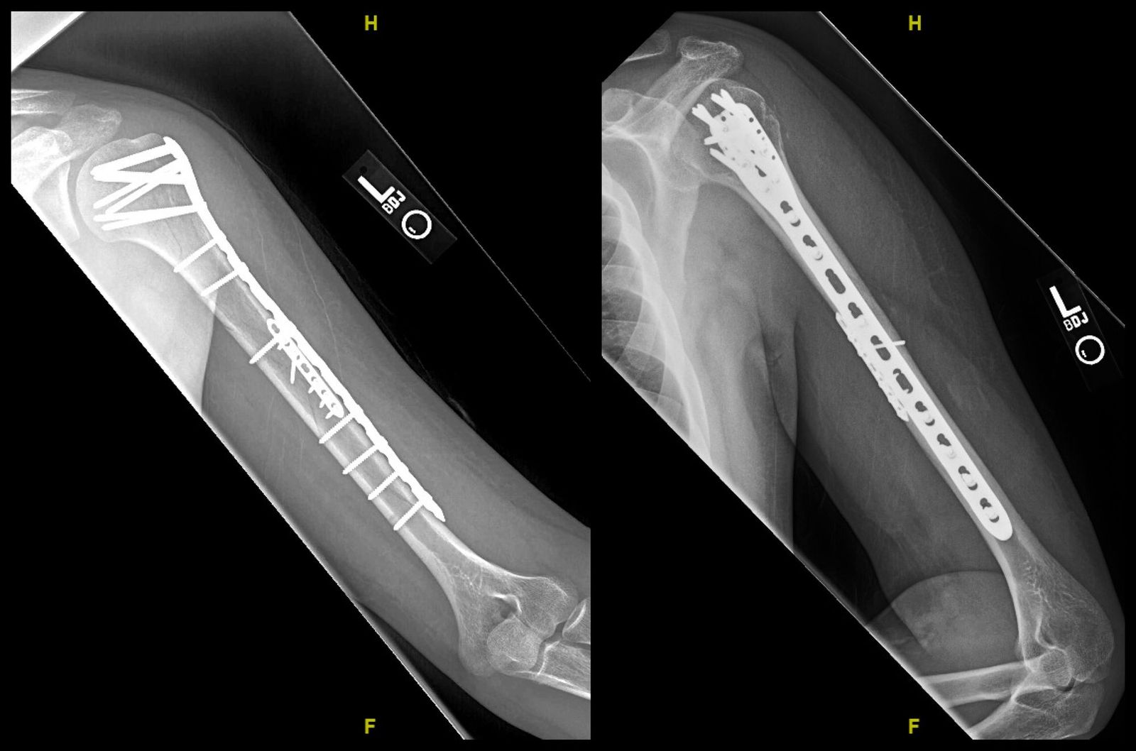 Segmental Humerus ORIF