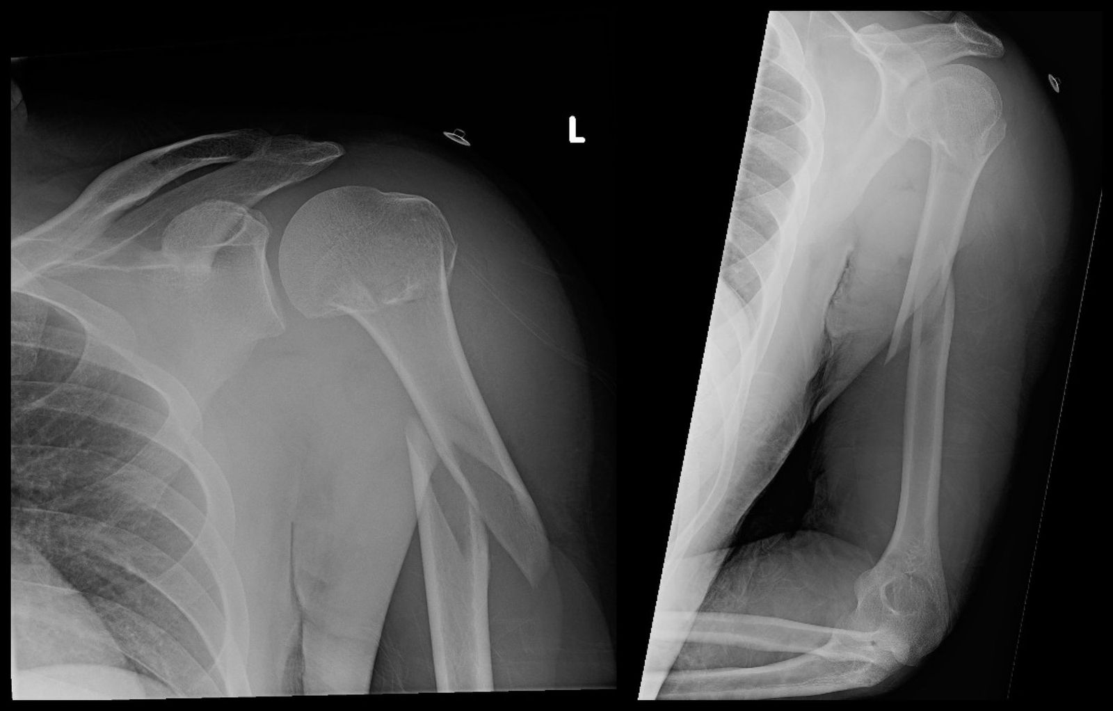 Segmental Humerus Orif