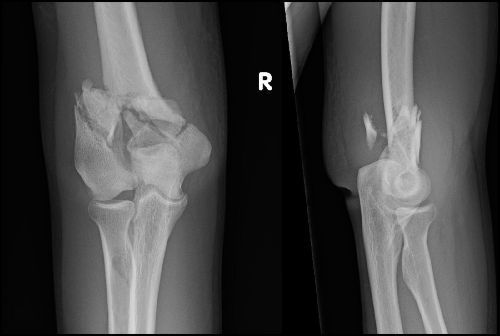 Intra-articular Distal Humerus ORIF