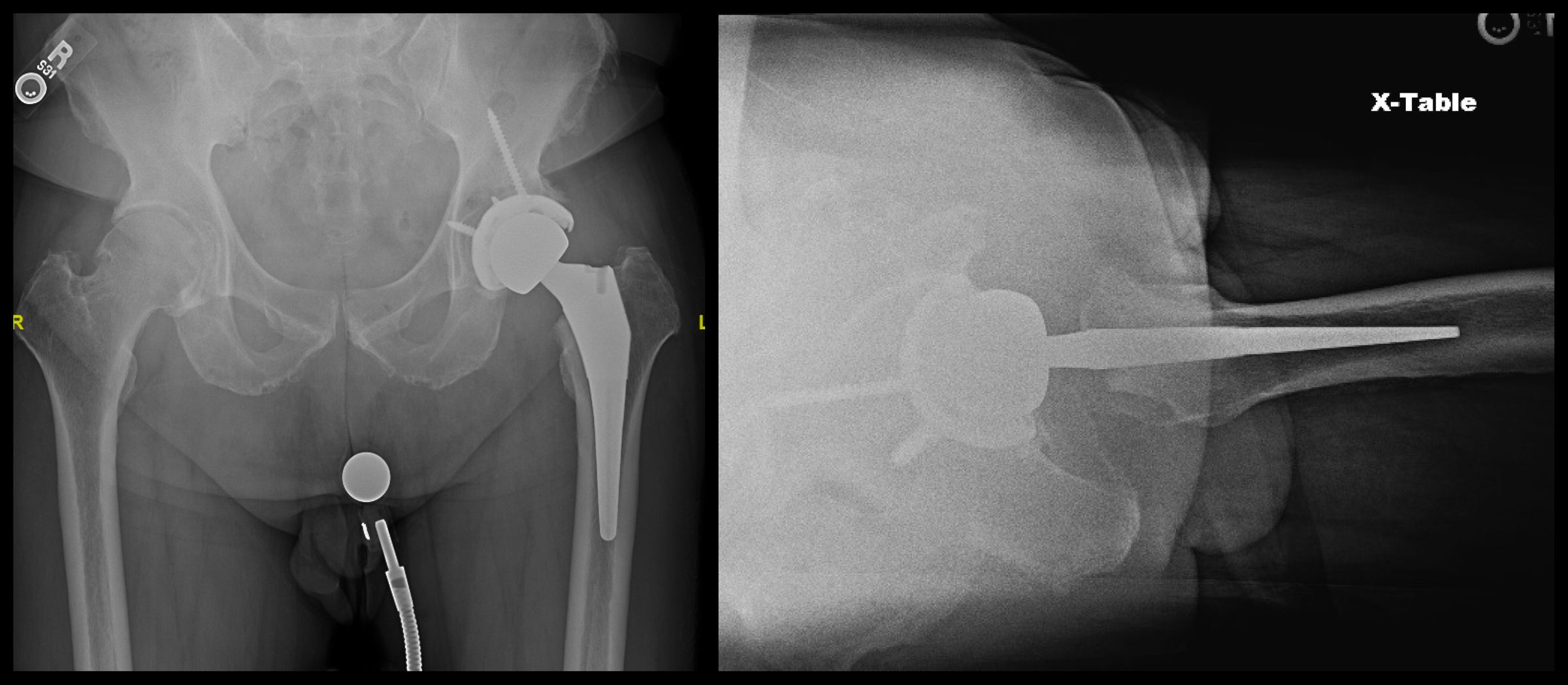 icd 10 code for post right total hip arthroplasty