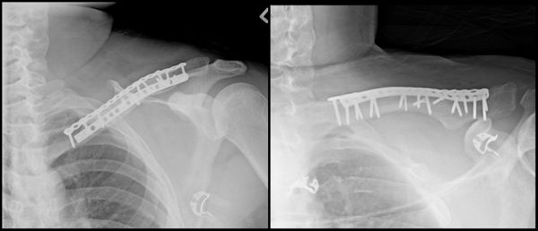 status post orif clavicle icd 10