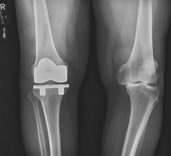 Total Knee Arthroplasty (Cementless, Robotic-assisted)